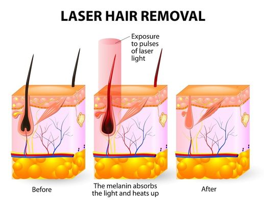 Dioden-Laser-Haar-Abbau-Maschine des Badekurort-Salon-20HZ 808