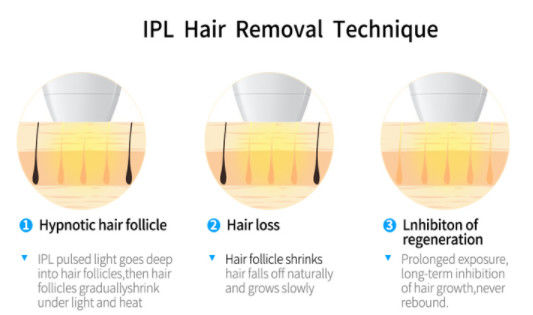 2000w DIODEN-Lasertechnologie OPTs IPL+ 808NM für Haarabbauausrüstung